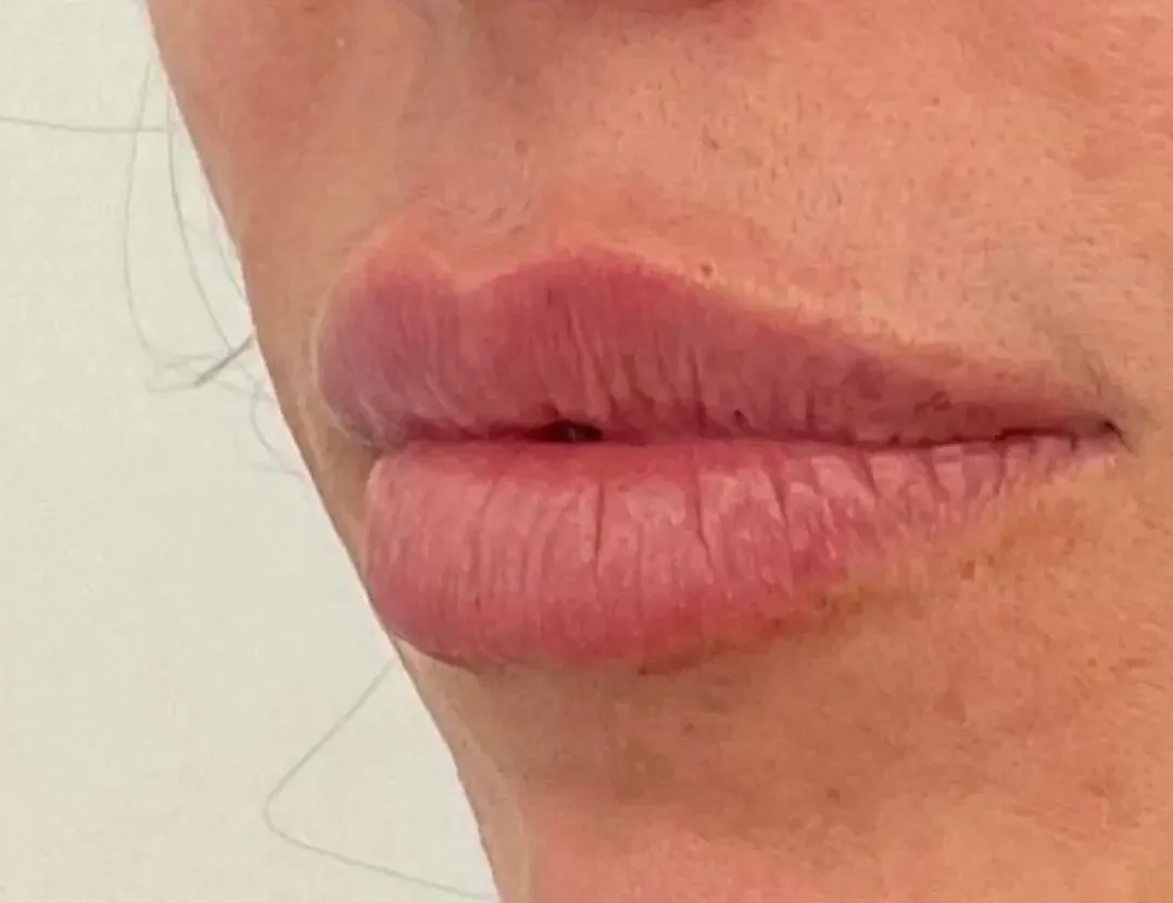 Aumento e hidratación de labios — después