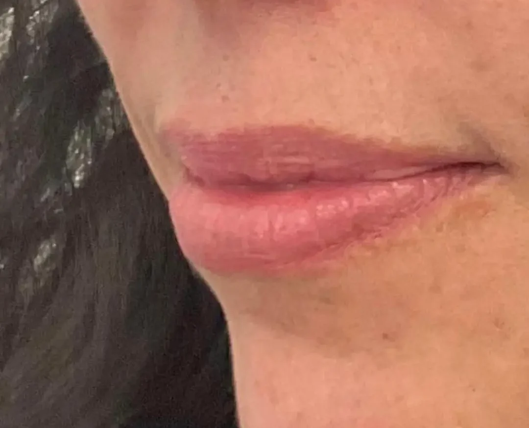 Aumento e hidratación de labios — antes