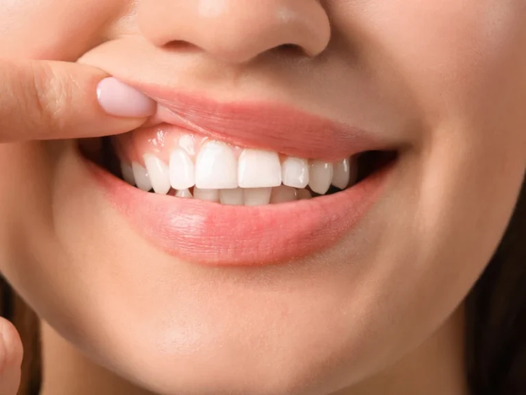 Sonrisa gingival